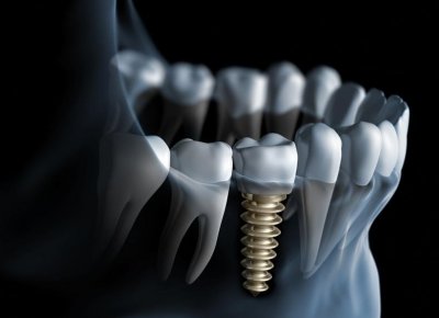 Практическая стоматология: импланты или протезы?