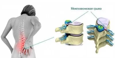 Как не допустить позвоночных грыж